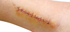 Sutures and surgical wounds: how to care for them properly