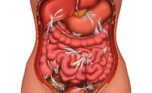 Symptoms of intestinal adhesions and their treatment + video