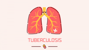 Tuberculosis: Everything about the symptoms, diagnosis and treatment of tuberculosis