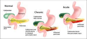 Causes Of Pancreatitis And Its Home Treatment Greenbhl