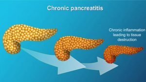 Causes of pancreatitis and its home treatment