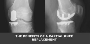 Who needs knee replacement surgery?