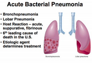 Symptoms that confirm pneumonia