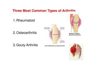 What are the main symptoms of arthritis?
