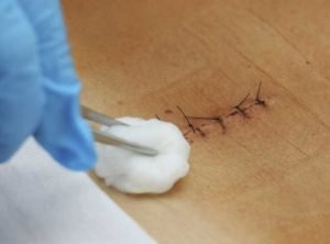 Sutures and surgical wounds: how to care for them properly
