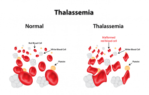 Thalassemia; Evaluation of symptoms, causes, and treatment methods