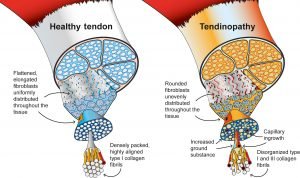 What are the main symptoms of arthritis?