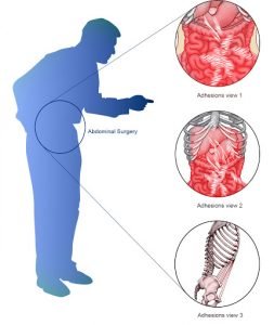 Symptoms of intestinal adhesions and their treatment + video