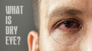 Causes of "dry eye" and the best ways to treat it