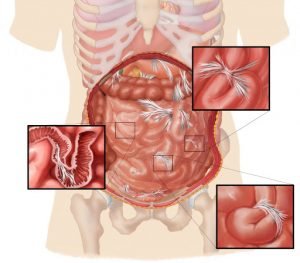 Symptoms of intestinal adhesions and their treatment + video