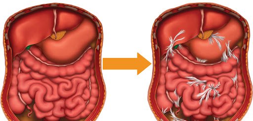 Symptoms of intestinal adhesions and their treatment