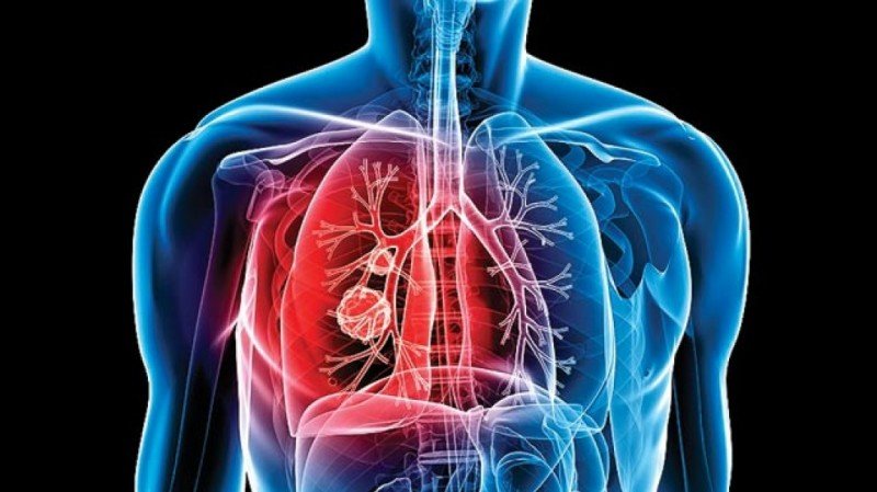 Tuberculosis: Everything about the symptoms, diagnosis and treatment of tuberculosis