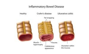 Autoimmune diseases; Causes, symptoms, types, and methods of treatment