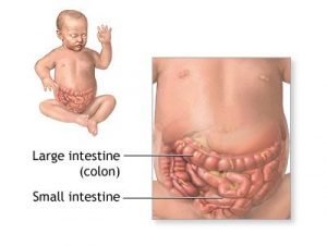 What is intestinal obstruction, and how is it treated?