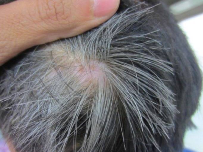 All the factors that can cause premature graying of hair