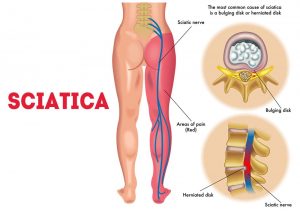 Everything about disc rupture or herniation