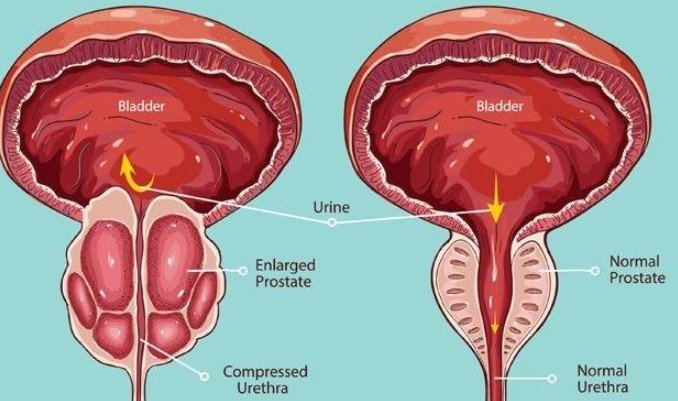 Do you know what prostate cancer is and how it is treated?
