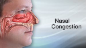 37 Quick and definitive treatment to relieve nasal congestion