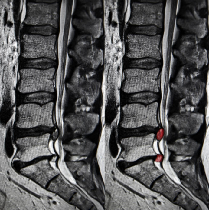 Everything about disc rupture or herniation
