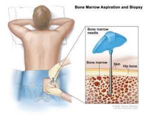 Does leukemia start with this symptom?