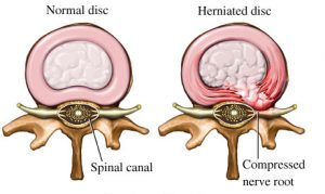 Everything about disc rupture or herniation