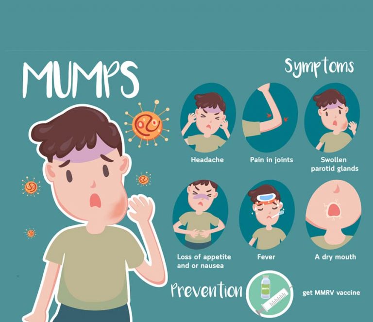 Mumps; Symptoms, methods of prevention and treatment