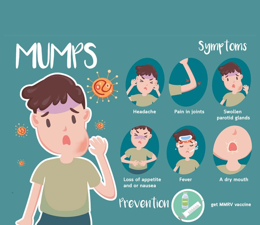 Mumps; Symptoms, methods of prevention and treatment – GreenBHL