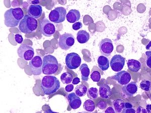 Does leukemia start with this symptom?