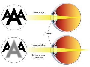 what are the types and causes of visual problems