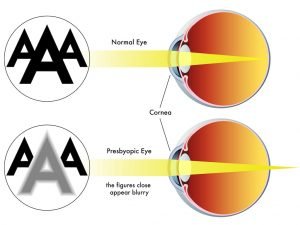 Types of eye problems and their causes