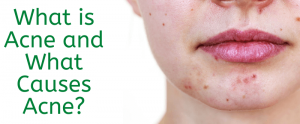 Which food causes pimples on the face and body?