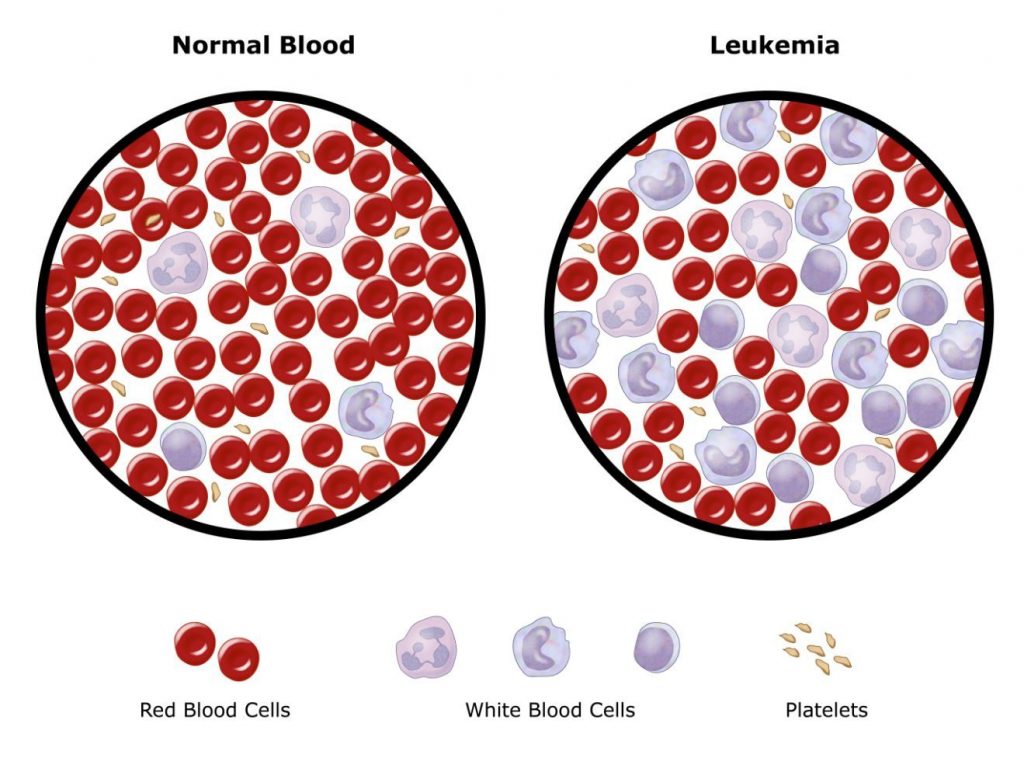 how does leukemia affect the patents life