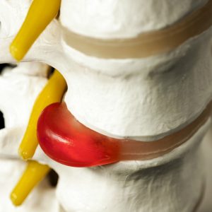 Everything about disc rupture or herniation