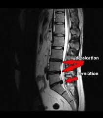 Everything about disc rupture or herniation