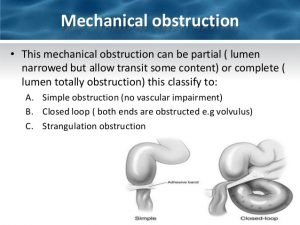 What is intestinal obstruction, and how is it treated?