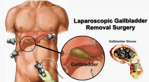 What is a gallbladder? How does it work in the body?