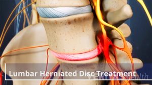 Everything about disc rupture or herniation