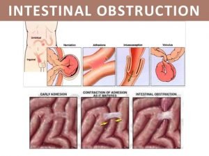 What is intestinal obstruction, and how is it treated?