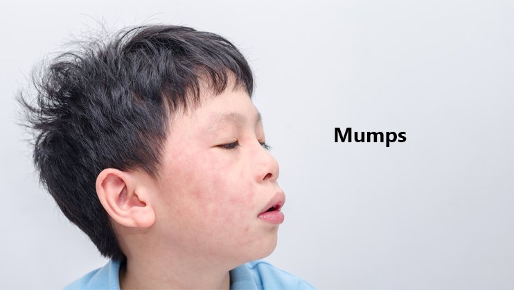 Mumps; Symptoms, methods of prevention and treatment