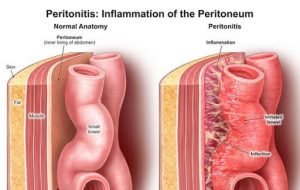 What is intestinal obstruction, and how is it treated?