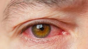 Types of eye problems and their causes