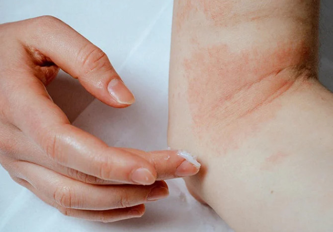 The best home remedies for eczema