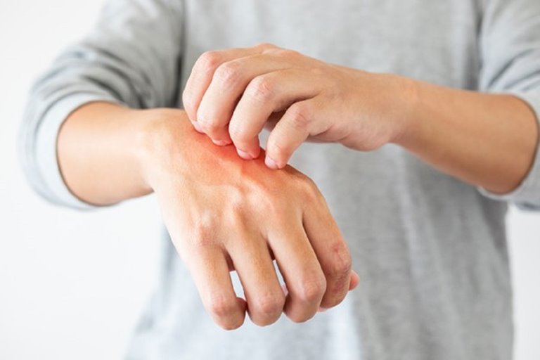 The best home remedies for eczema