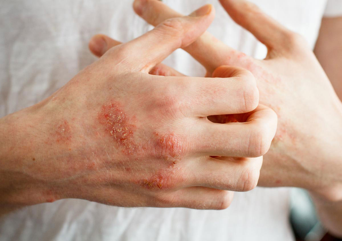 The best home remedies for eczema
