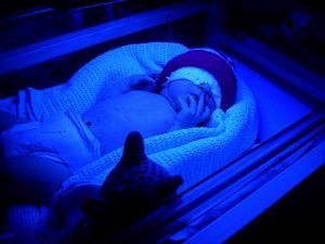 What you need to know about jaundice and its treatment