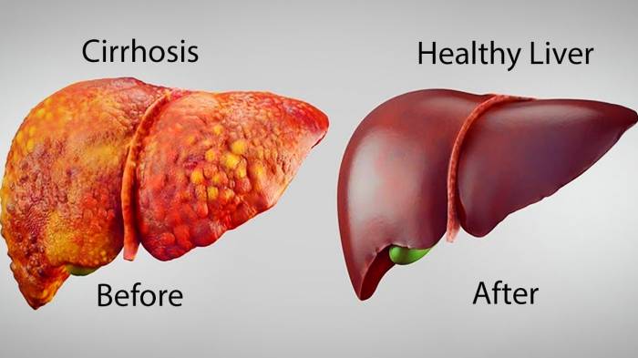 Everything about liver detoxification regimens