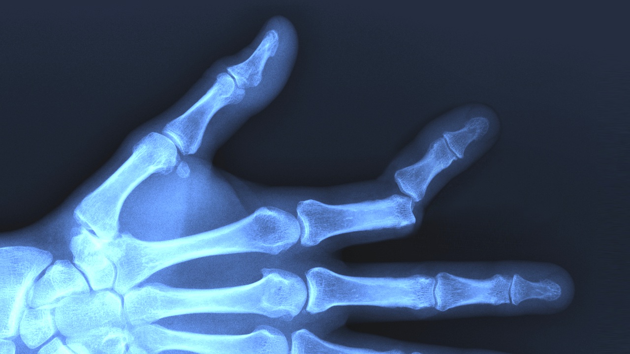 finger bone fractures