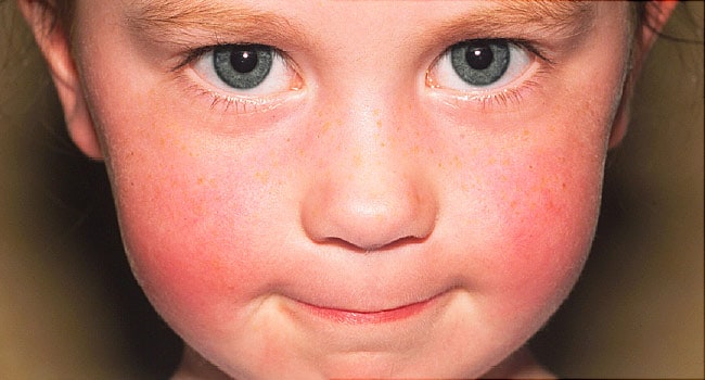 Common Baby Skin problems in infants