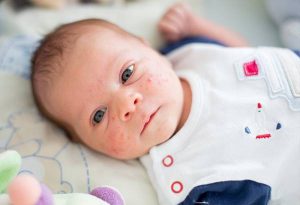 Common Baby Skin problems in infants