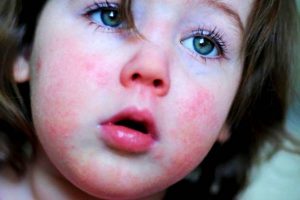 Common Baby Skin problems in infants
